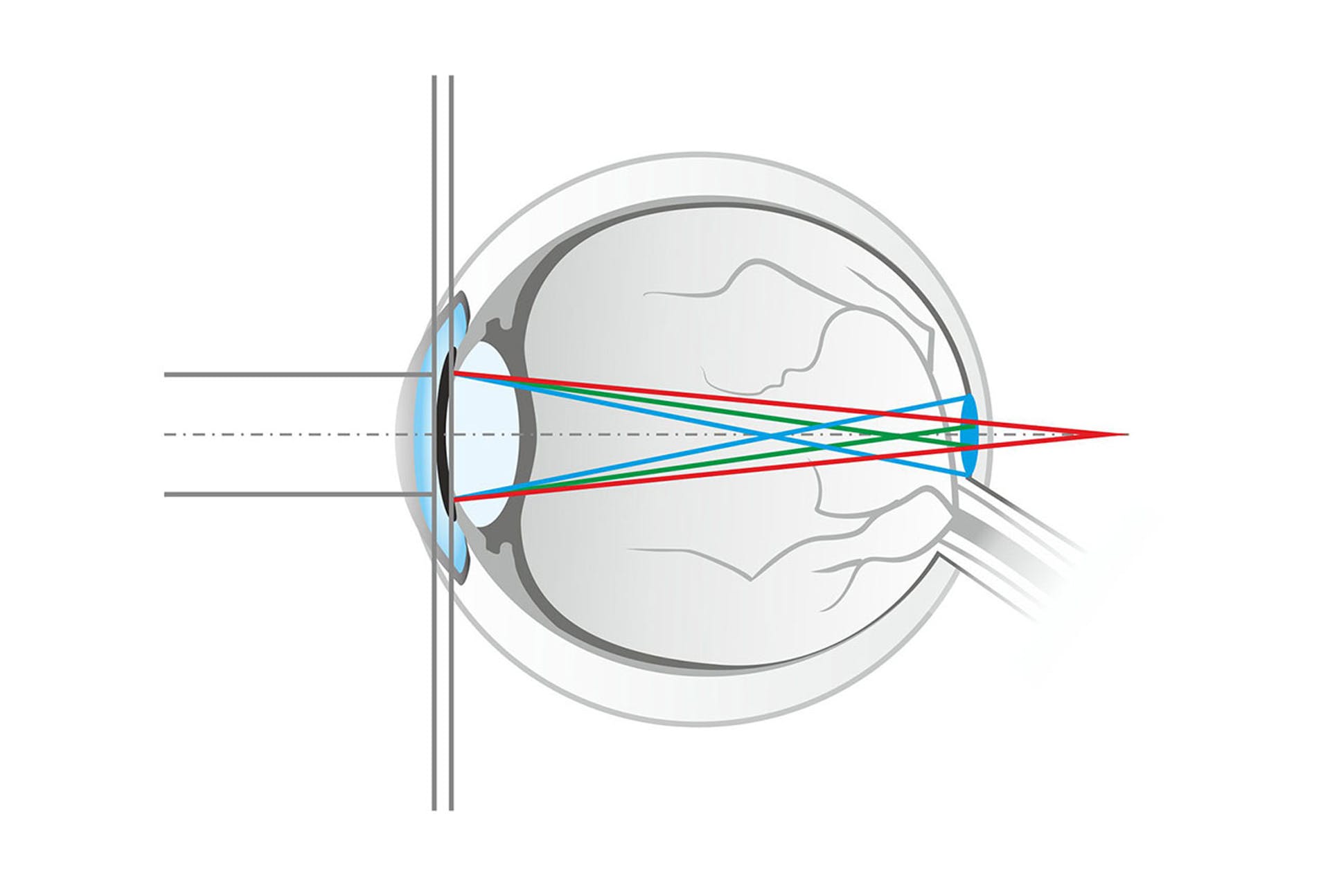 hogyan lehet pénzért javítani a látást orvoslás módja a látás javítására